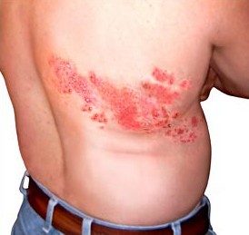 Как выглядит лишай у человека