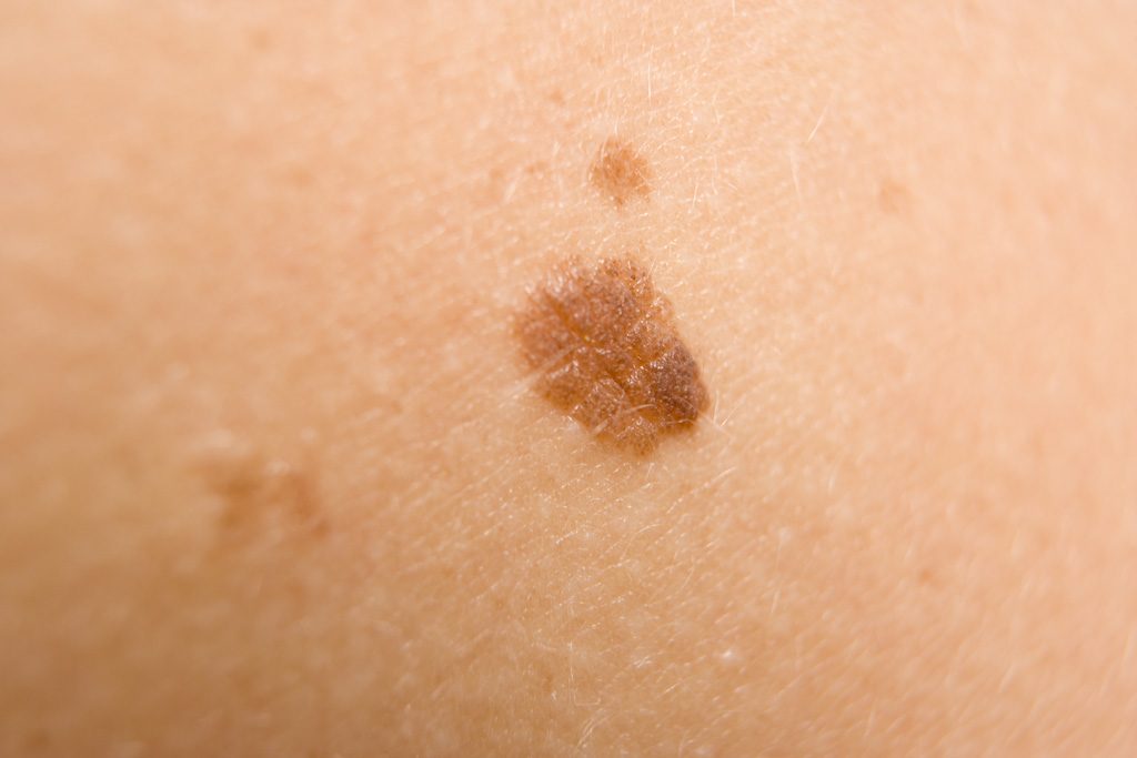 melanoma-foto1-1930595