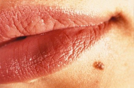 melanoma-foto2-9876581